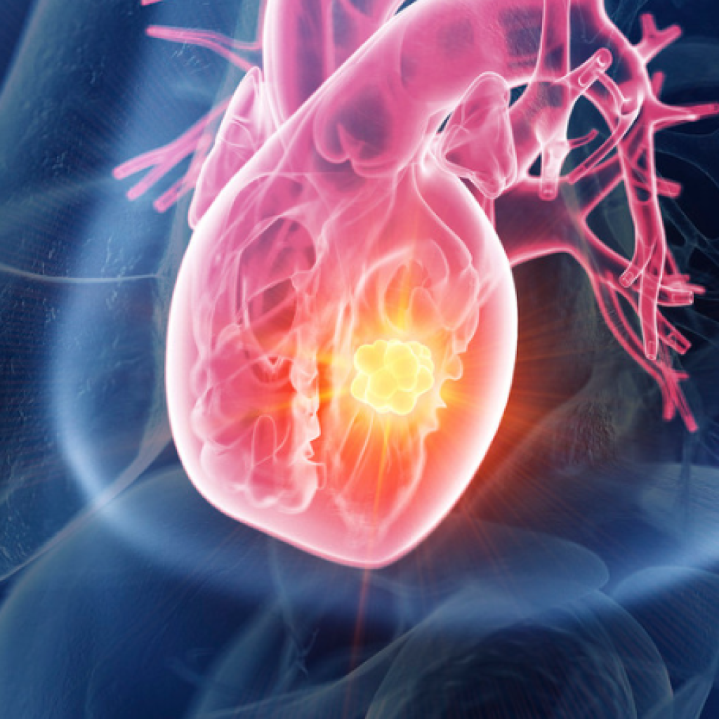 Arythmie cardiaque : Peut-on vivre normalement? Réponses d'experts