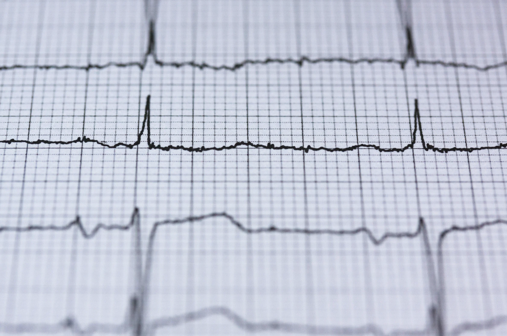 ecg au repos